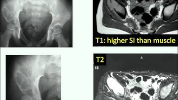 BONE TUMOR IMAGING