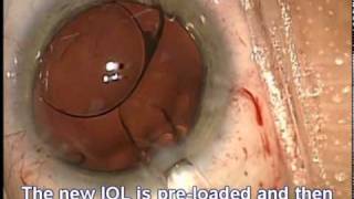 Lens Exchange Cataract Implant surgery by Uday Devgan MD of Los Angeles