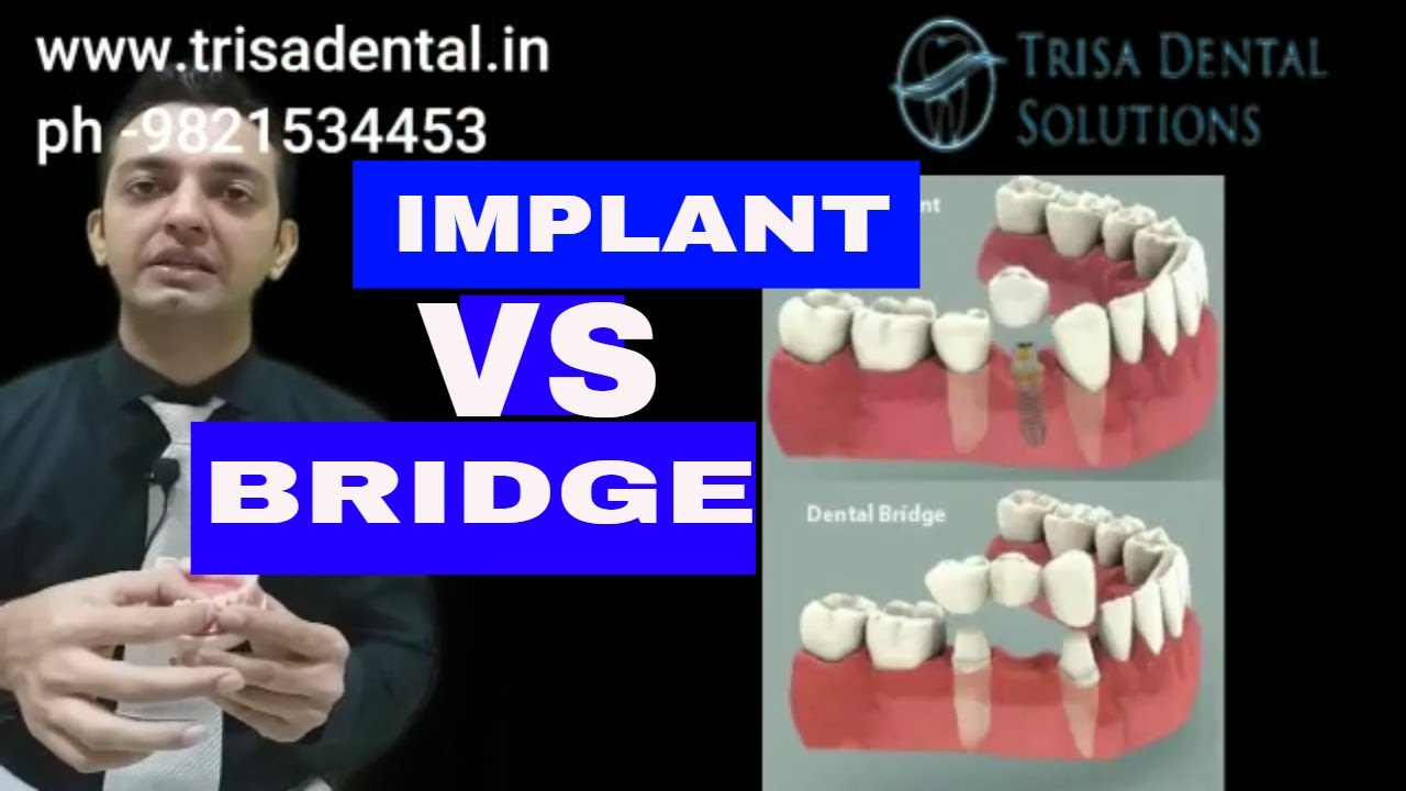 Which is better implant or bridgeDental bridge or implant decision
