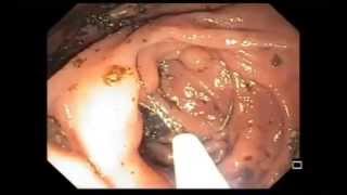 видео Тубулярная аденома желудка: причины и способы лечения