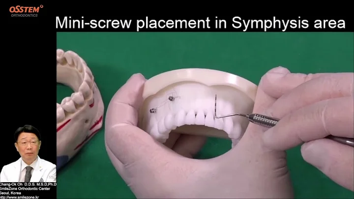 9. Symphysis (When and How to use "Orthodontic Screw")