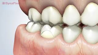 Introducing Precision Aligner Buttons