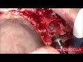 Implant msc coaxis