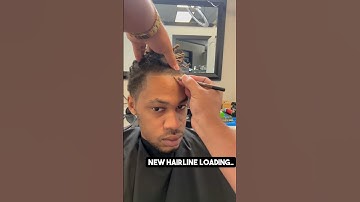 Hairline transformation loading! 1st SMP session complete! #shortsviral #wow #hairloss #shorts