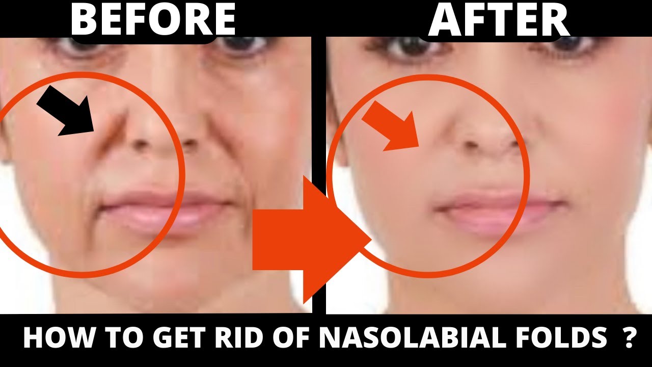 FACE LIFTING MASSAGE NASOLABIAL FOLDS ( BUCCAL MASSAGE) JOWLS, SAGGY