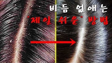 비듬 없애는법, 비듬 1도 없는 두피 만드는 비법