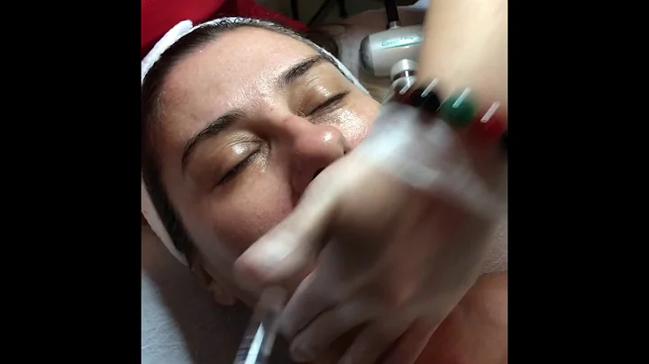 Microneedling with Epidermal Growth Factor
