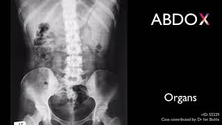 ABDO X - approach to abdominal x-ray interpretation screenshot 5