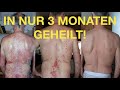 Schuppenflechte - in 3 Monaten geheilt ohne Kortison