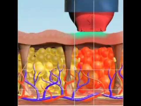 cirujano plastico puerto rico Thermage. El último avance para combatir el envejecimiento - Clínica Correa