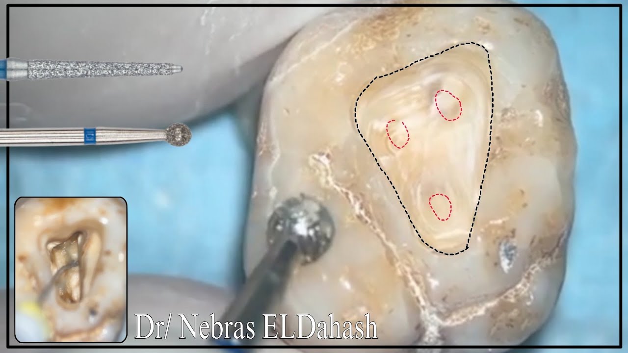 Upper Molar Access cavity preparation YouTube