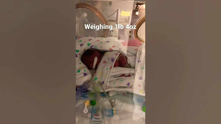 Premature baby born at 26 weeks from IUGR and Preeclampsia