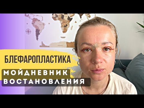 Восстановление после блефаропластики по дням. Блефаропластика результат после 9 месяцев