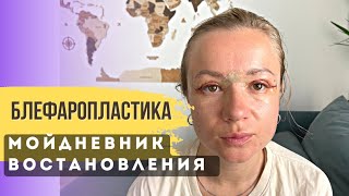 Восстановление после блефаропластики по дням. Блефаропластика результат после 9 месяцев