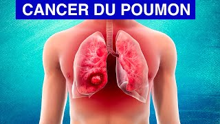 Cancer Du Poumon : Symptômes Et Traitements