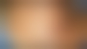 Mini- Incision Focused Parathyroidectomy