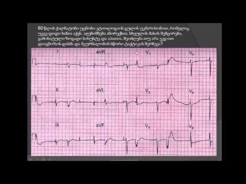 მოციმციმე არითმია და ჯგუფური ვენტრიკულური ექსტრასისტოლია / საგულე გლიკოზიდებით ინტოქსიკაცია