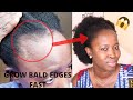 THIS TREATMENT WILL GROW & TREAT YOUR BALDNESS & THIN EDGES FAST IN 1 MONTH(Use 3 times weekly)