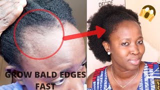 THIS TREATMENT WILL GROW & TREAT YOUR BALDNESS & THIN EDGES FAST IN 1 MONTH(Use 3 times weekly) screenshot 2