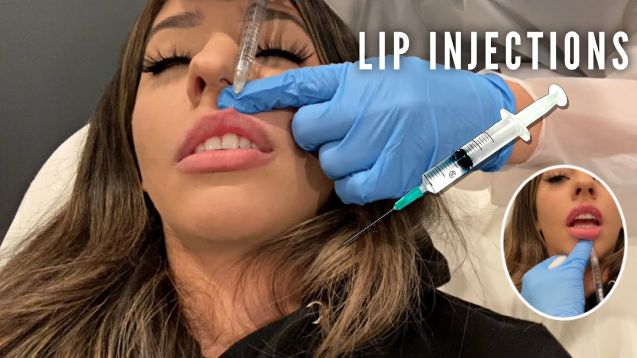 Lip Filler Vlog At Laser Away | Beverly Hills