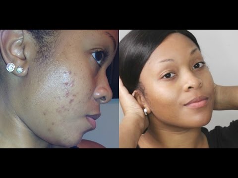 How To: Get Rid Of Dark Spots/Fade Acne Scars & Get Clear Skin