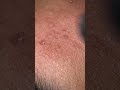 Black head part 2