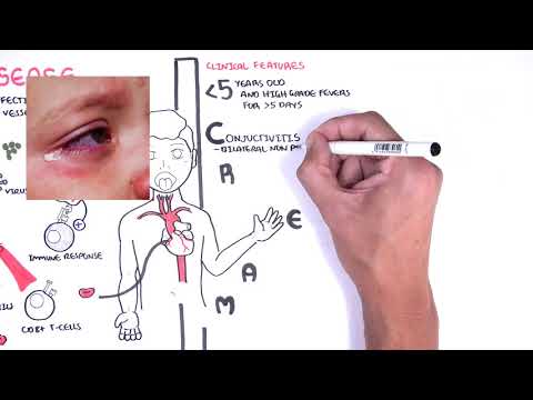 Kawasaki Disease vasculitis - symptoms,  pathophysiology, treatment