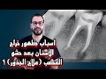 اسباب ظهور الخراج بعد حشو العصب علاج الجذور د عبدالسلام محمد التجمع الخامس