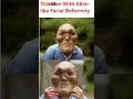 The Man With Alien like Facial Deformity