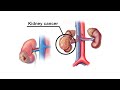 Mayo clinic minute  how is kidney cancer treated