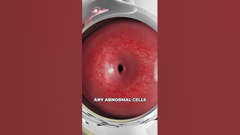 Taking a sample from the cervix (3D Animation)