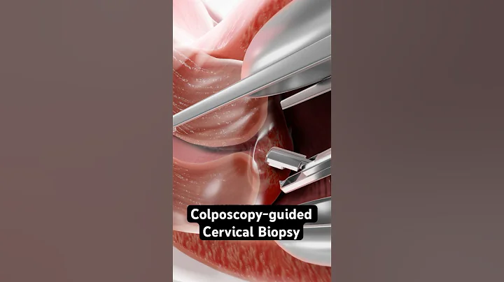 Taking a sample from the cervix (3D Animation)