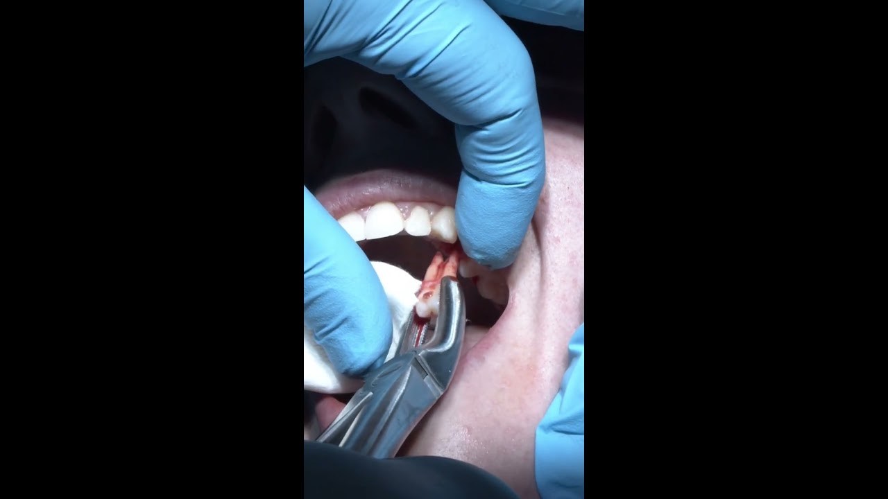 Tooth Extraction For Orthodontic Purposes Shorts Dentist Slowmo