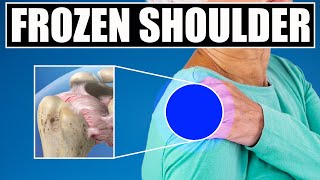 Frozen Shoulder. BEST Exercises, Stretches & Treatments for Shoulder Pain Relief Adhesive Capsulitis
