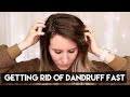 HOW TO GET RID OF DANDRUFF FAST WITH COCONUT OIL | The benefits of a coconut oil hair mask