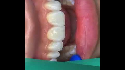 THAY ĐỔI DÁNG RĂNG - CHO NỤ CƯỜI KHỞI SẮC