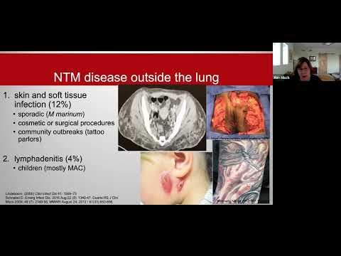 The Changing Face of Nontuberculous Mycobacterial (NTM) Disease: Lady Windermere shares the Stage