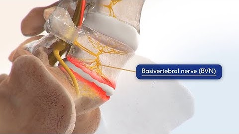 Intracept Procedure for Chronic Low Back Pain