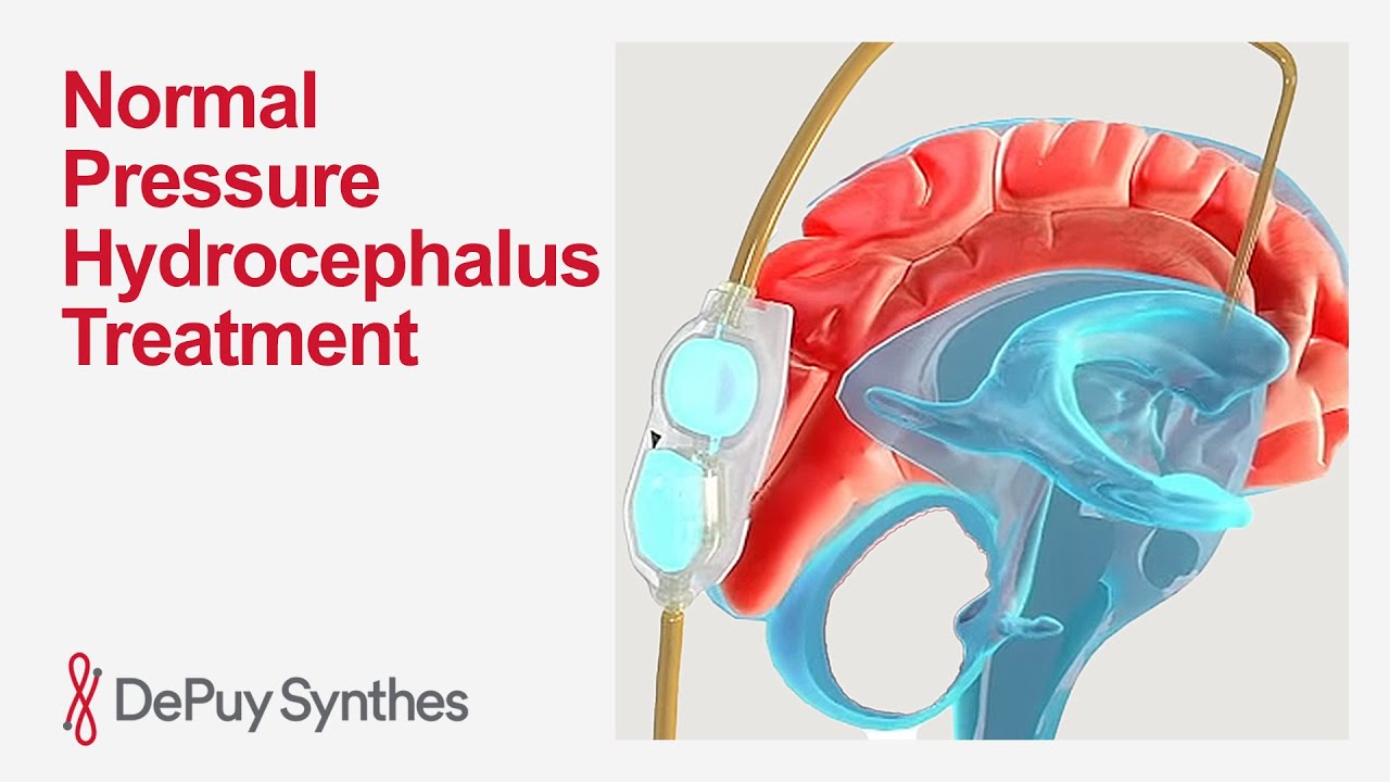 Шунтирование при нормотензивной гидроцефалии: чего ожидать | DePuy Synthes