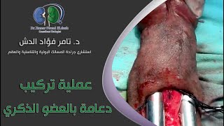 عملية تركيب دعامة بالعضو الذكري - دكتور تامر فؤاد الدش