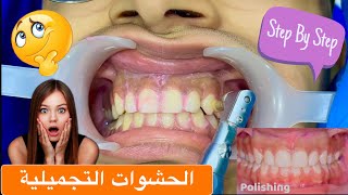 حشوات تجميلية ل الأسنان الأمامية | كيف تتم ؟ | Composite restoration step by step