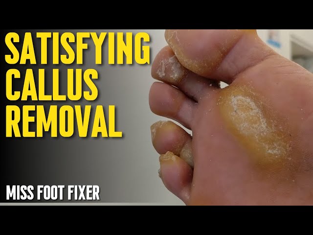 Removing a MASSIVE Callus  Satisfying Foot Callus Removal