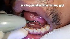 Karang gigi dan noda rokok 25 tahun gak pernah dibersihkan - Durasi: 4.30. 