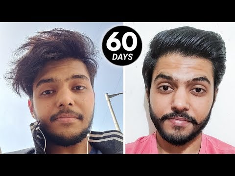 i-tried-minoxidil-for-60-days-!!-(-honest-results-)-🇮🇳