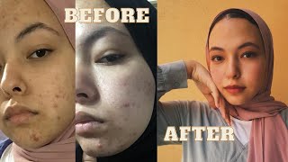 HOW I GOT RID OF MY ACNE FOREVER!ازاي اتخلصت من الحبوب و تجربتي مع نت لوك