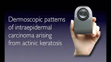 SCC in situ by Dr. Iris Zalaudek