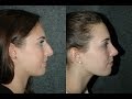 Rhinoplasty Long Island &amp; New York City #estrhinoplastyresults