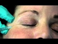 Botox Injected into the Crows Feet.. Softening of the Laugh Lines