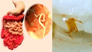 The Most Disturbing Parasites Found Inside Humans! How I'm Curing Myself | Monsters Inside Me