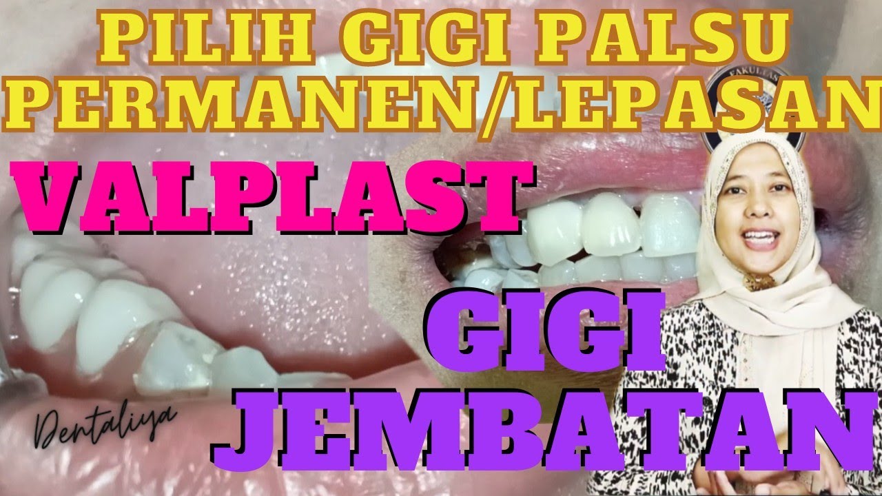 PILIH GIGI PALSU PERMANEN APA LEPASAN? SESUAI KEBUTUHAN, KENYAMANAN & HARGA #GIGIJEMBATAN #VALPLAST